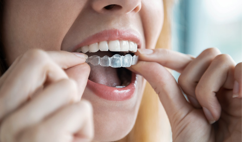 Invisalign zalety leczenia