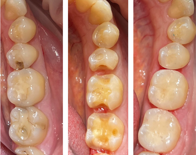 Skuteczne leczenie próchnicy