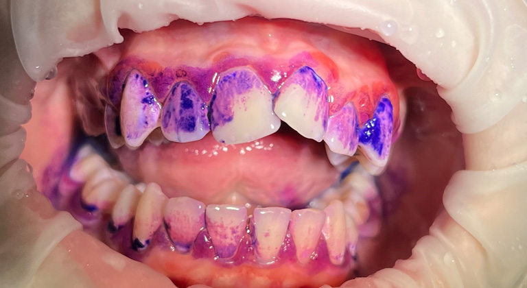 Wybarwianie płytki nazębnej